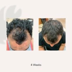 Actiiv Hair Science Recover Thickening Cleansing Treatment For Men -Care Product Store Actiiv Hair Science Recover Thickening Cleansing Treatment for Men Before After