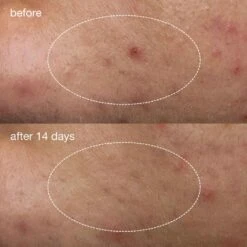 Dermalogica Deep Acne Liquid Patch -Care Product Store Dermalogica Deep Acne Liquid Patch 4