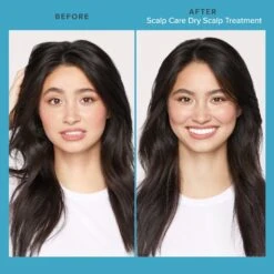 Living Proof Scalp Care Dry Scalp Treatment -Care Product Store LivingProof ScalpCare DryScalp Treatment Before After Image